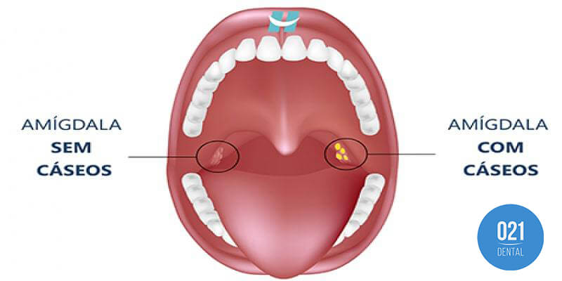 O que são bolinhas amarelas na garganta #caseum #amigdalitis