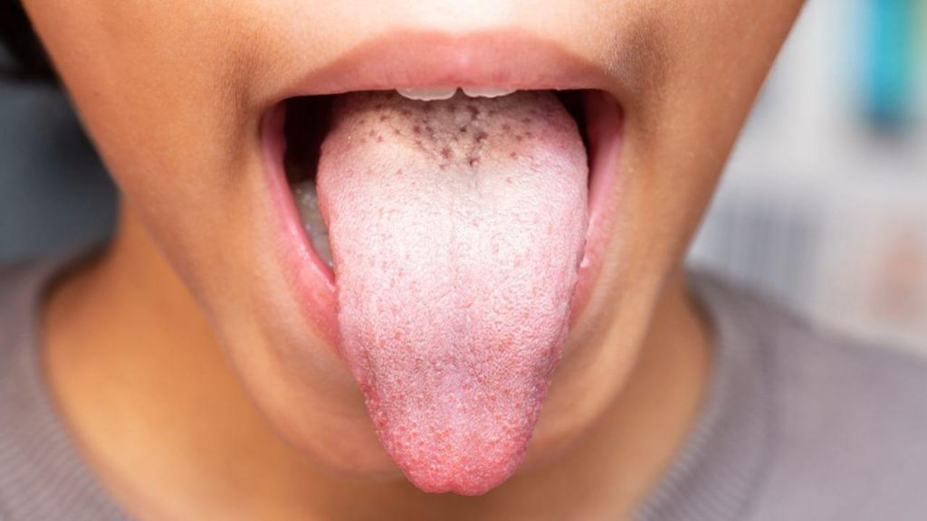 Saiba quais são as principais causas das bolinhas na língua